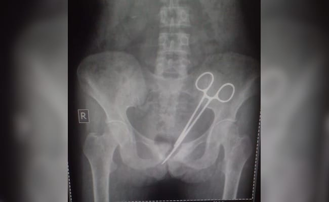 Doctors Leave Pair Of Scissors In Woman’s Abdomen, It Is Found 12 Years Later