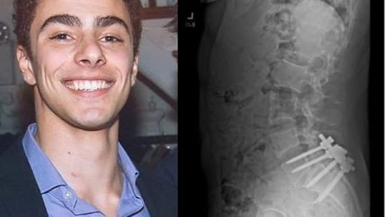 Why did Luigi Mangione kill UnitedHealth CEO? ‘Painful’ again surgical procedure, social media posts, and a pretend ID